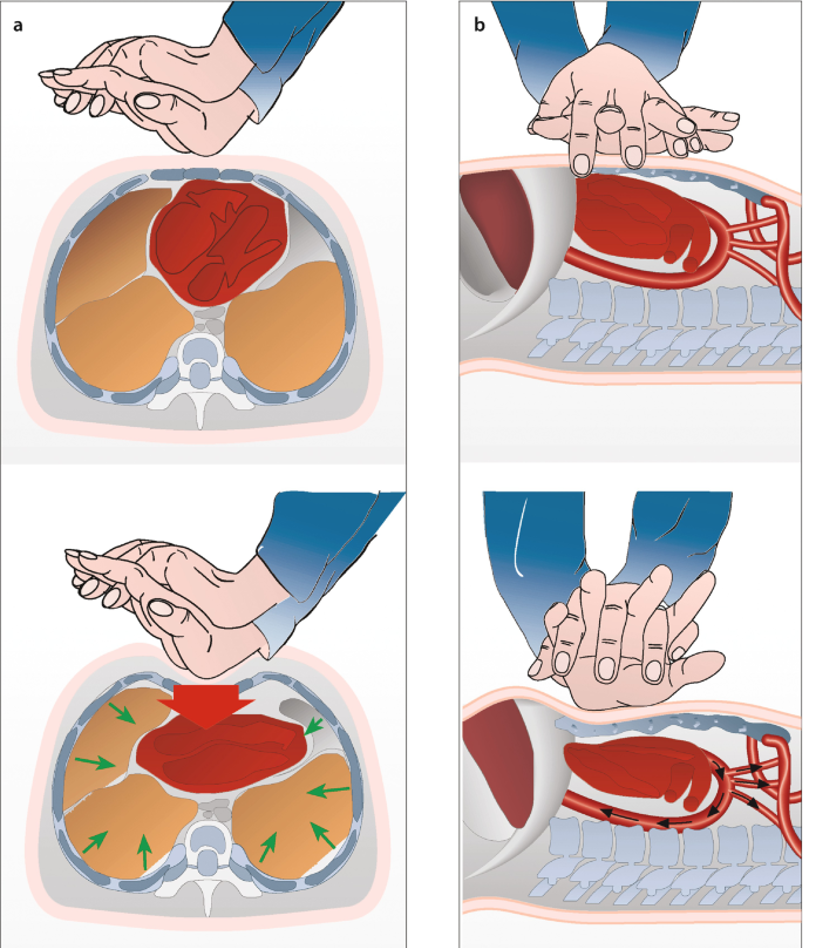 Position der Brustkorbdruckmassage